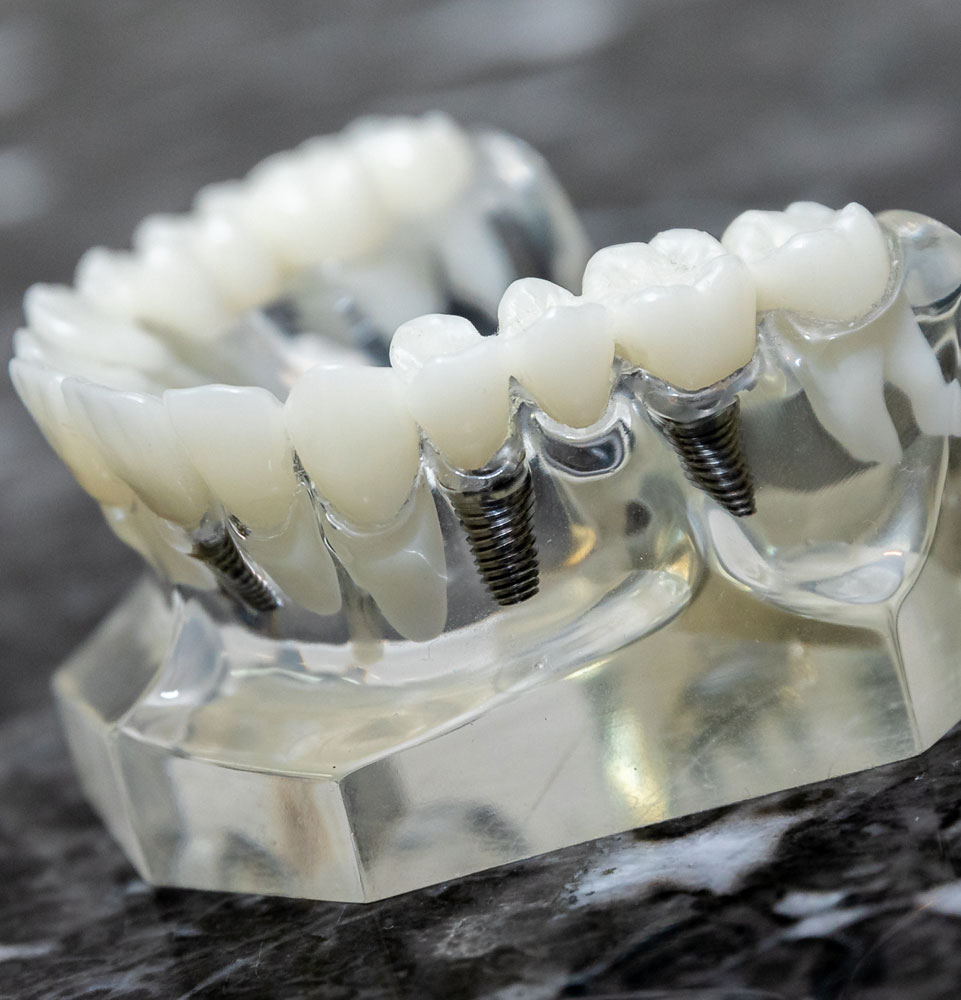 dental bridge model on countertop