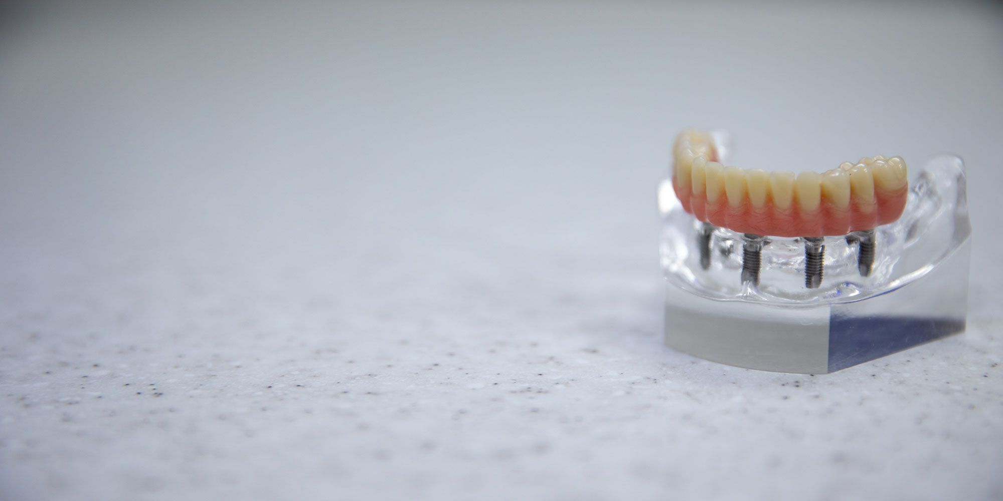 fullmouth dentalimplant on table