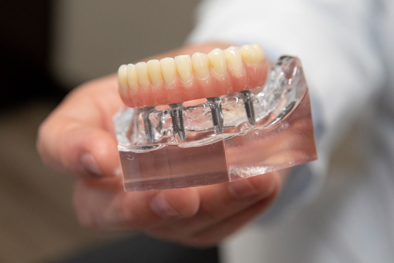 fullmouthdentalimplant model held by dentist