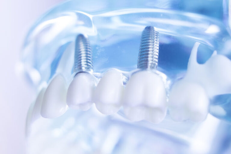 3D illustration of a maxillary fixed restoration with four dental implants, showing how implants support dental prosthetics for a secure and functional fit.