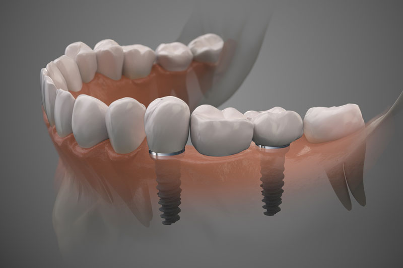 Unveiling the Process: Your Journey to Dental Implants with Dr. Lee, Aurora, CO