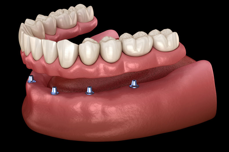 All On 4 Dental Implants: A Comprehensive Guide | Aurora CO
