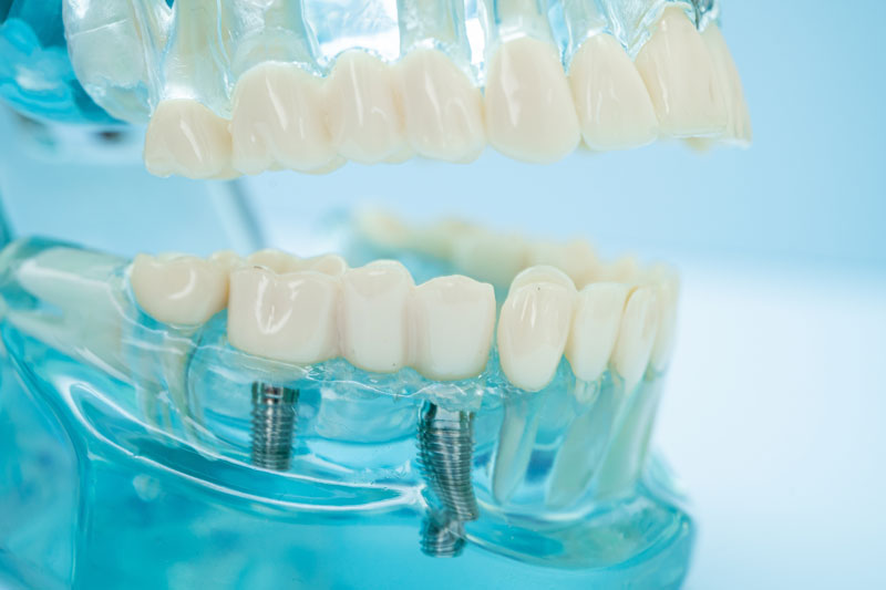 3D illustration of a maxillary fixed restoration with four dental implants, showing how implants support dental prosthetics for a secure and functional fit.
