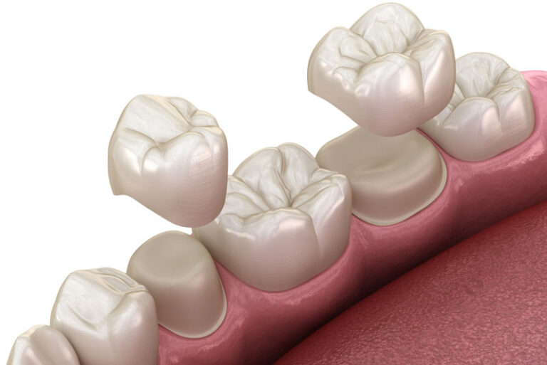 porcelain crown over two teeth pre molar and molar tooth