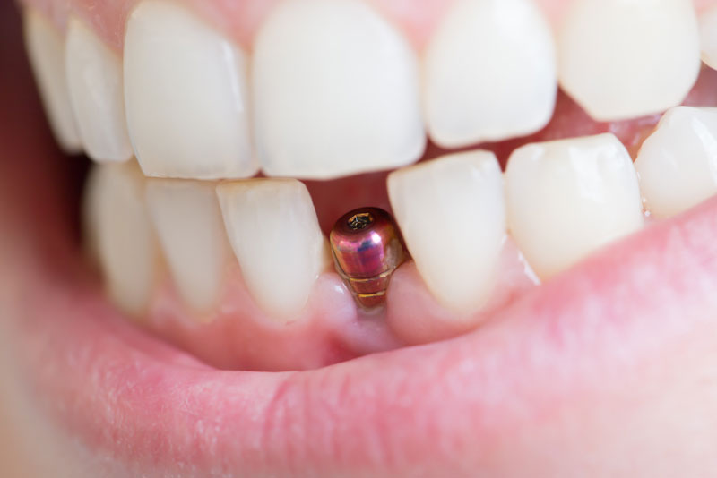 tooth implant in patient's mouth